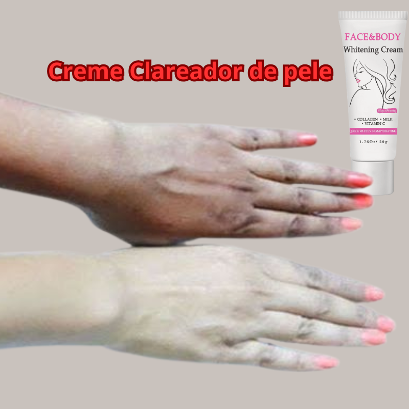 Creme Clareador de Pele| Tirar manchas de acne